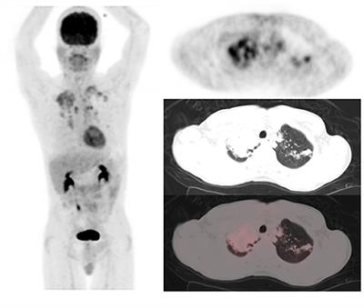 Correlation Between CT Features of Active Tuberculosis and Residual Metabolic Activity on End-of-Treatment FDG PET/CT in Patients Treated for Pulmonary Tuberculosis